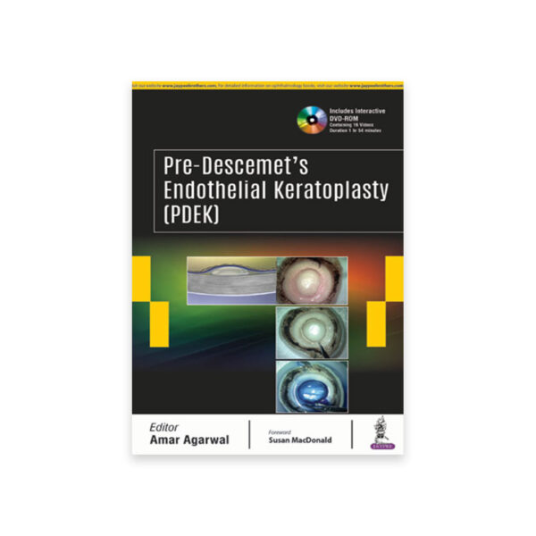 Pre-Descemet’s Endothelial Keratoplasty (PDEK)