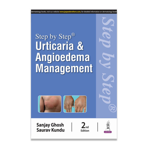 Step By Step Urticaria And Angioedema Management