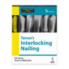Tanna's Interlocking Nailing